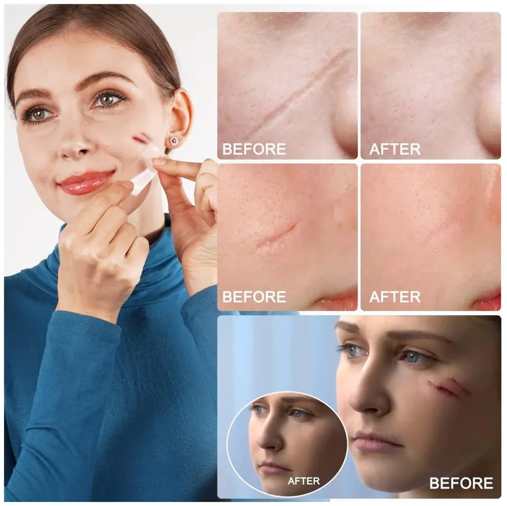 Bioline Clear Silicon Scar Sheet 4 x 150 Cm for Healing Scars Transparent tear silicone tape roll for hypertrophic scars and keloids caused by surgery, medical silicone for scar removal