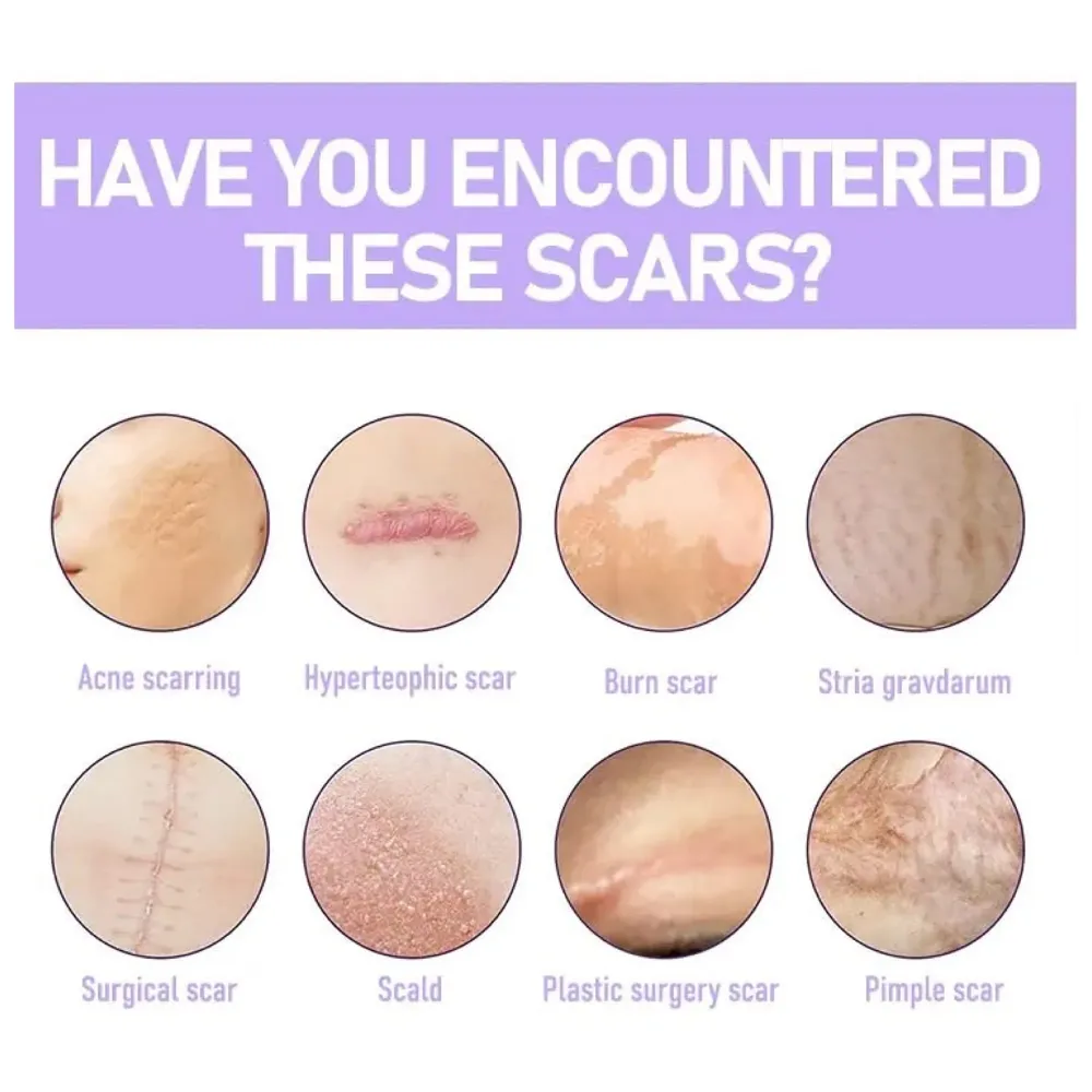 Bioline Clear Silicon Scar Sheet 4 x 150 Cm for Healing Scars Transparent tear silicone tape roll for hypertrophic scars and keloids caused by surgery, medical silicone for scar removal